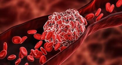 Prevención eficaz de la trombosis venosa profunda: la importancia de la terapia secuencial con Hemo-Force II