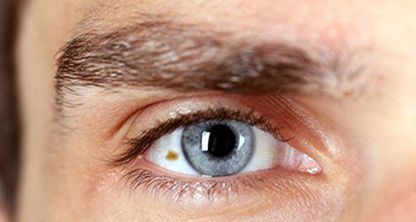 Síntomas que alertan de un melanoma ocular, un tipo de cáncer frecuente